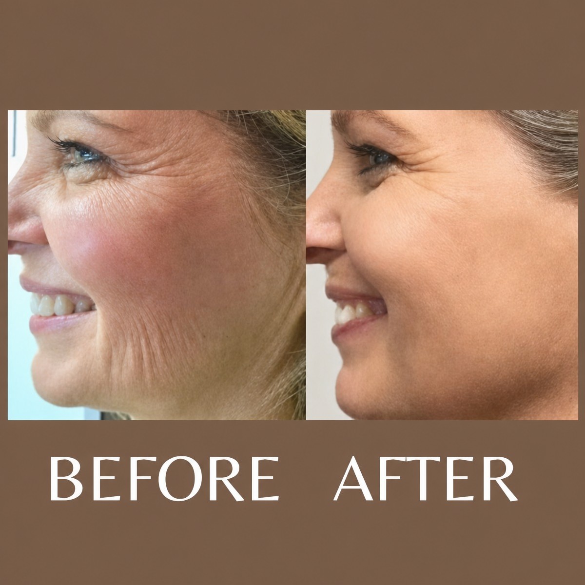 Before and after laser skin resurfacing at ID Clinic Bangkok, reduced wrinkles and smoother skin