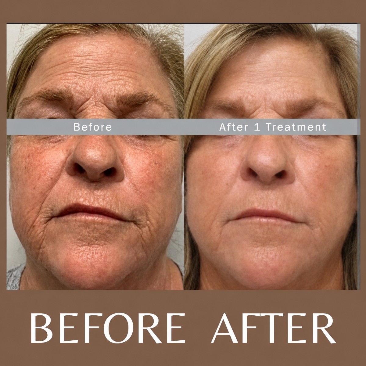 Before and after laser skin resurfacing at ID Clinic Bangkok, facial rejuvenation results