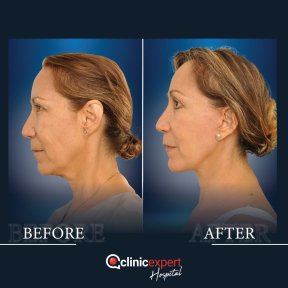 Premium Facelift surgery All Inclusive