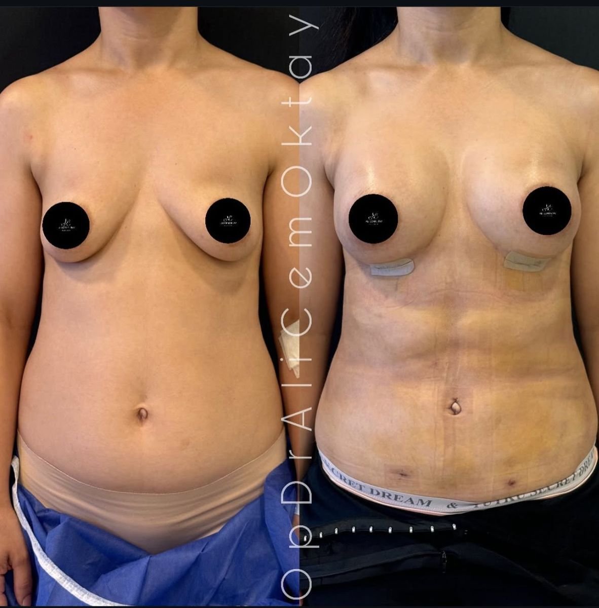 Resultados de abdominoplastia antes y después en Adem and Havva Medical Center, abdomen definido