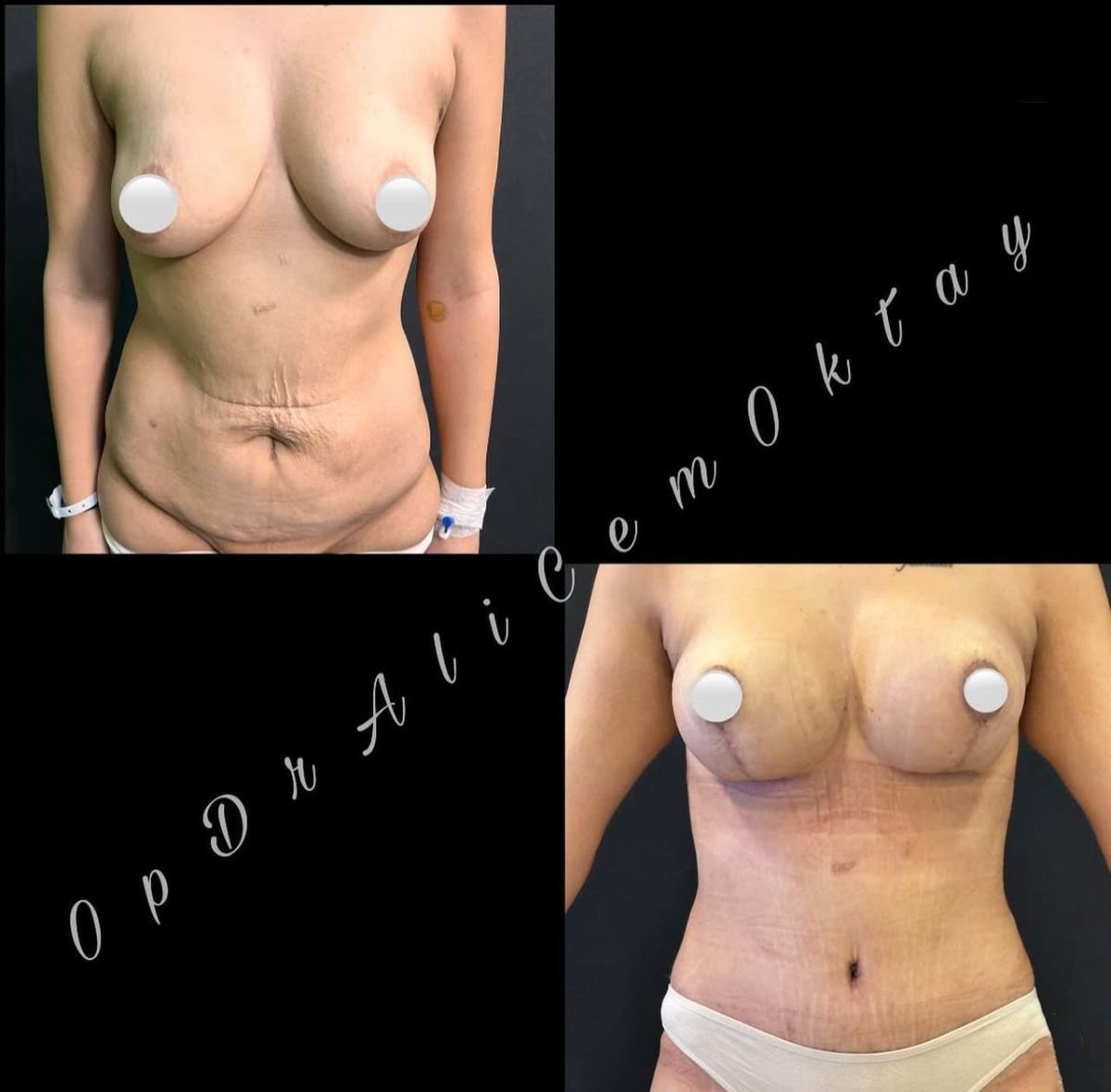 Resultados de abdominoplastia antes y después en Adem and Havva Medical Center, abdomen definido