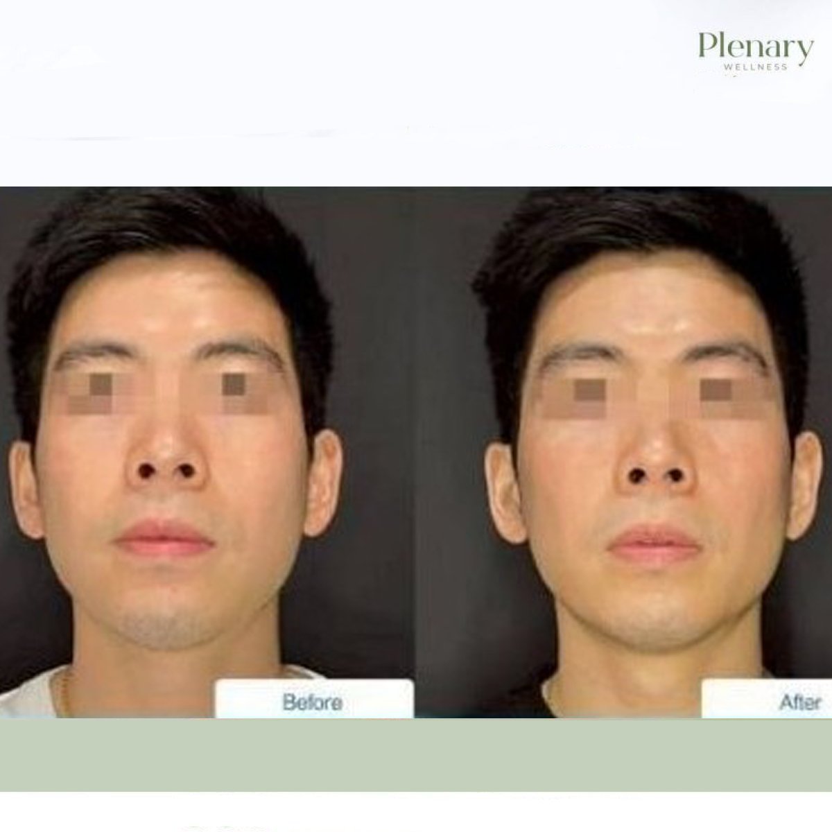 نتائج علاج تحفيز الوجه قبل وبعد في عيادة Plenary Wellness