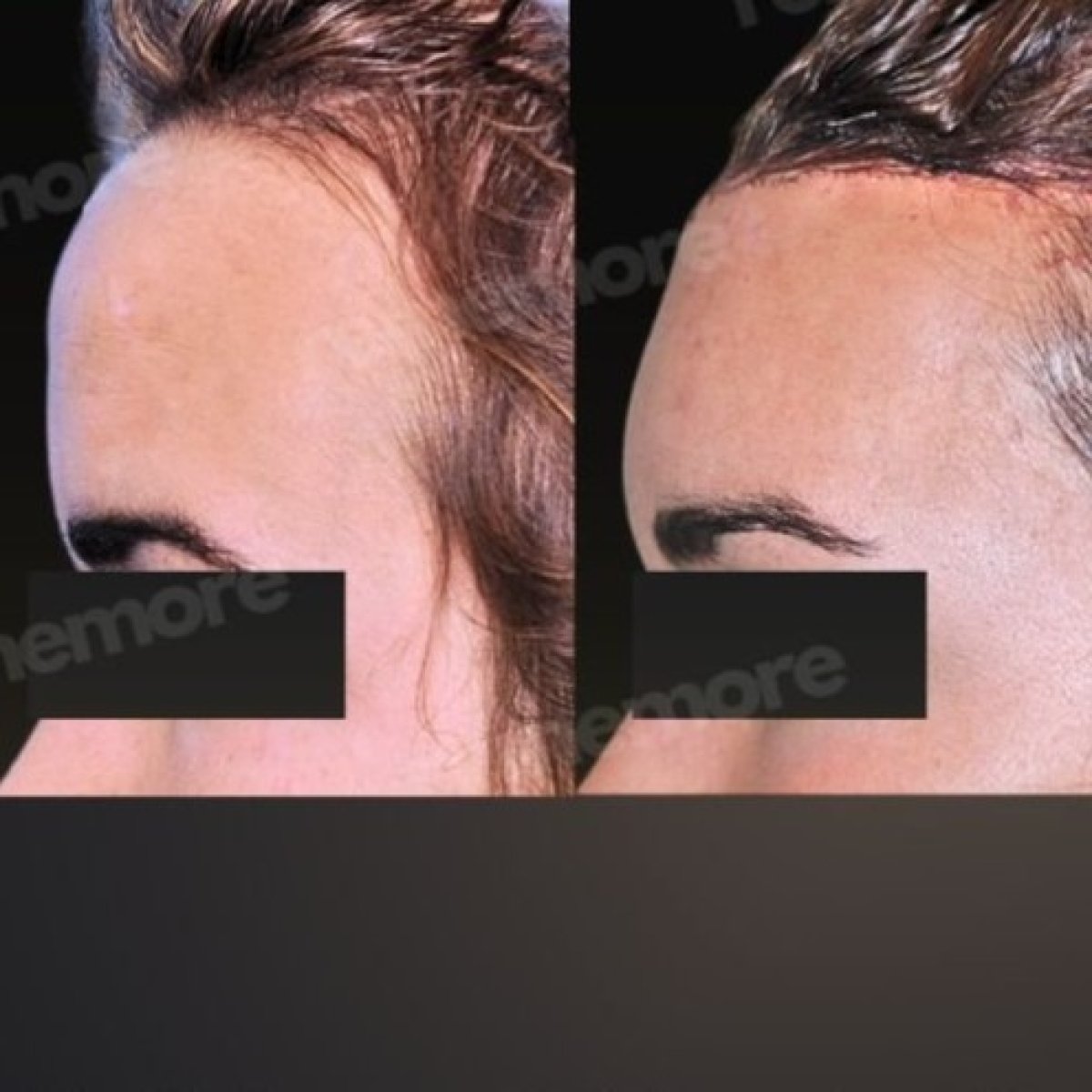 Resultados de cirugía de feminización facial antes y después en Memorial Bahçelievler Hospital