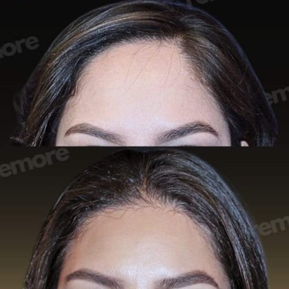 Resultados de cirugía de feminización facial antes y después en Memorial Bahçelievler Hospital, frente