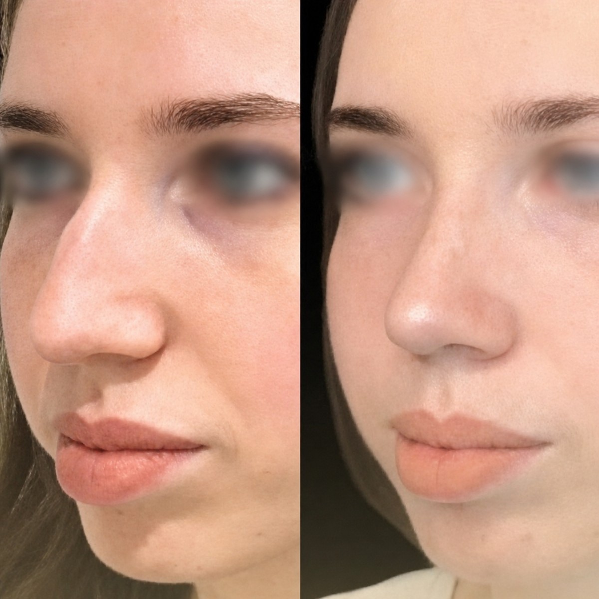 Resultados de cirugía de feminización facial antes y después en Memorial Bahçelievler Hospital