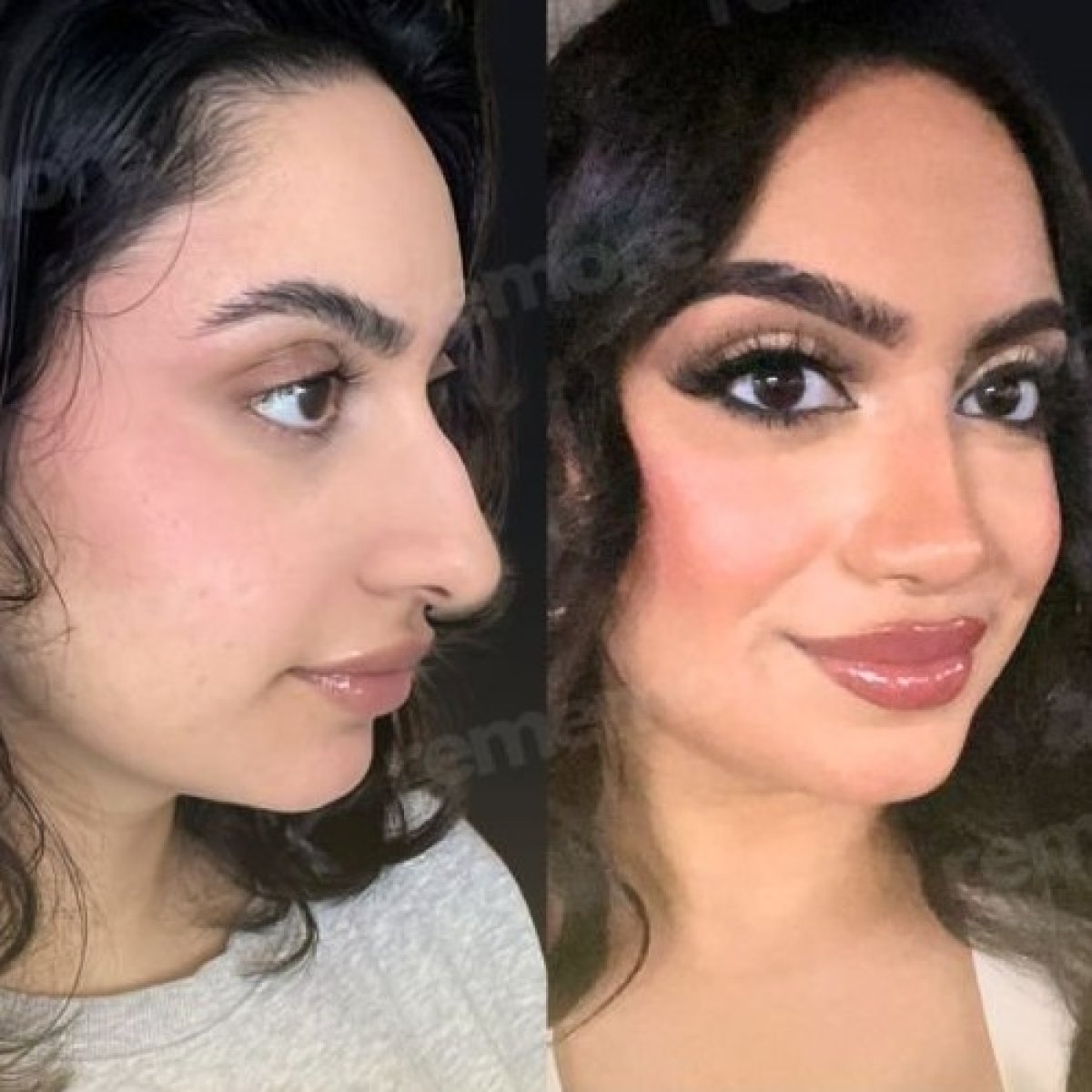 Resultados de cirugía de feminización facial antes y después en Memorial Bahçelievler Hospital