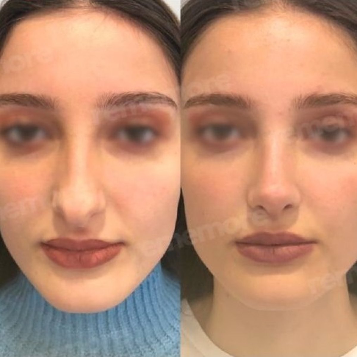Resultados de cirugía de feminización facial antes y después en Memorial Bahçelievler Hospital