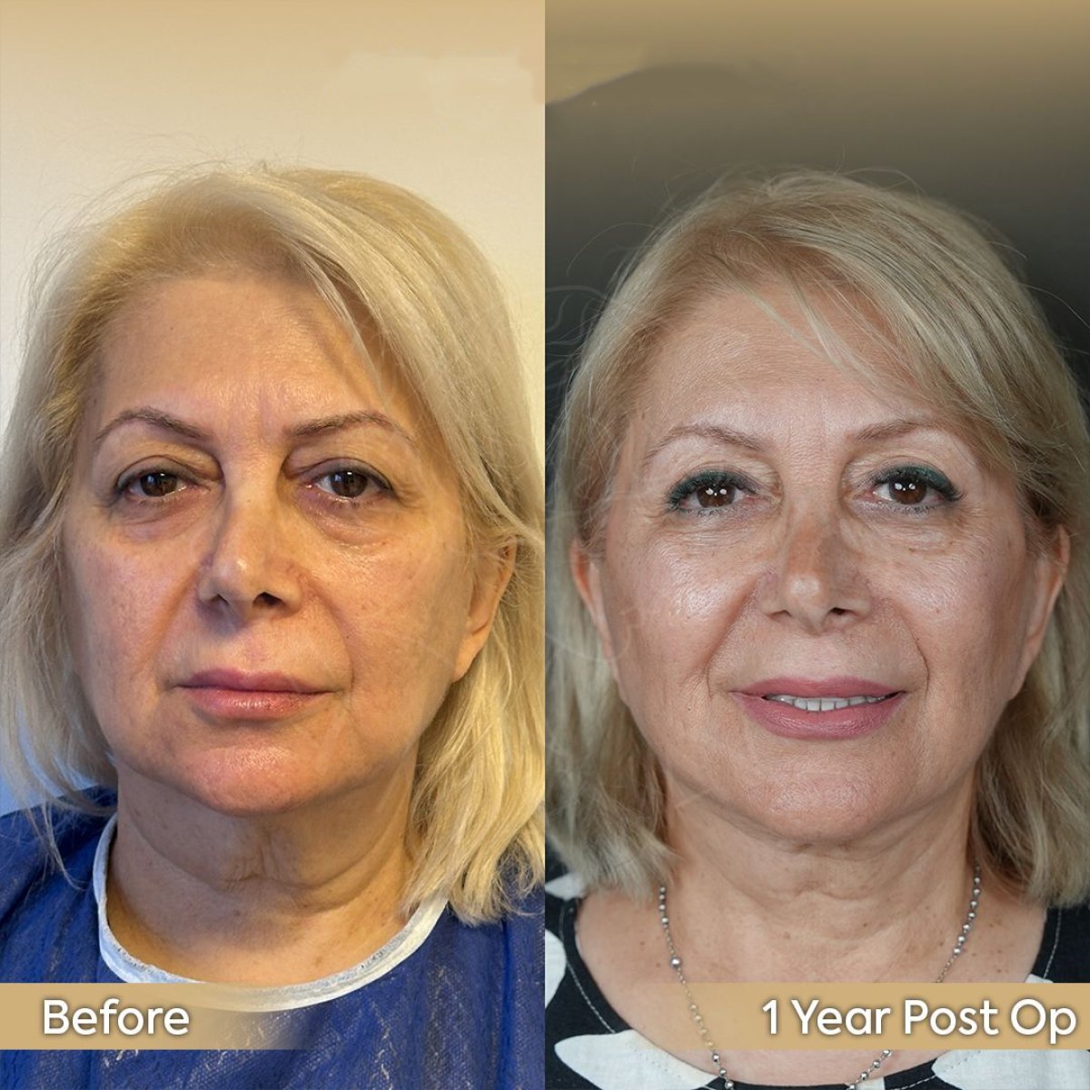 Resultados de lifting de cejas antes y después en Dr. Safa Manav Clinic, rejuvenecimiento tras 1 año
