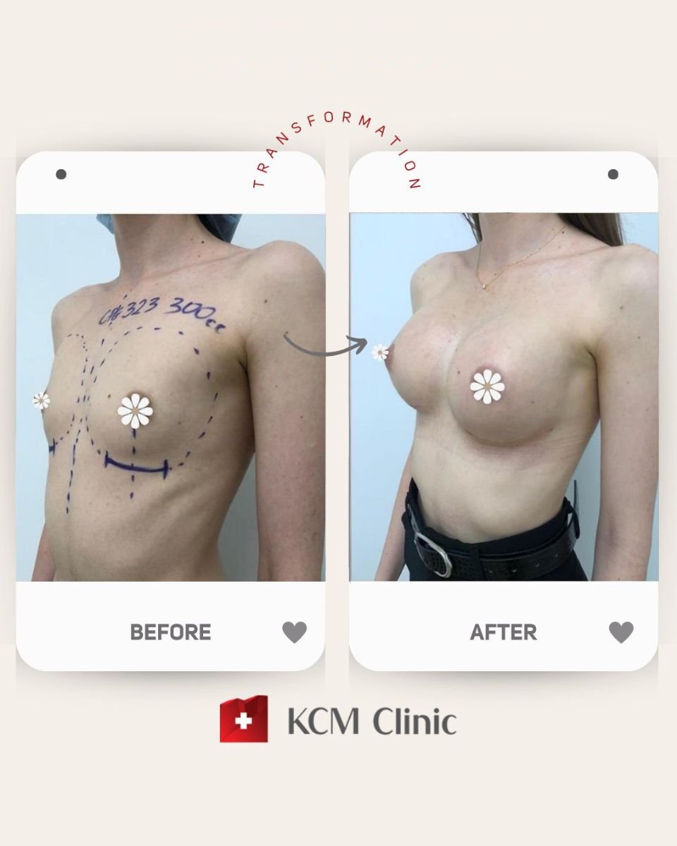 Resultados de lifting de senos antes y después en KCM Clinic, mejora visible del contorno