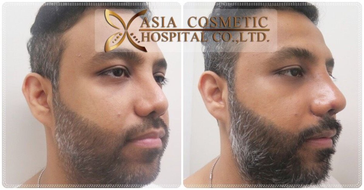 Before and after beard transplant results at Asia Cosmetic Hospital, fuller beard appearance
