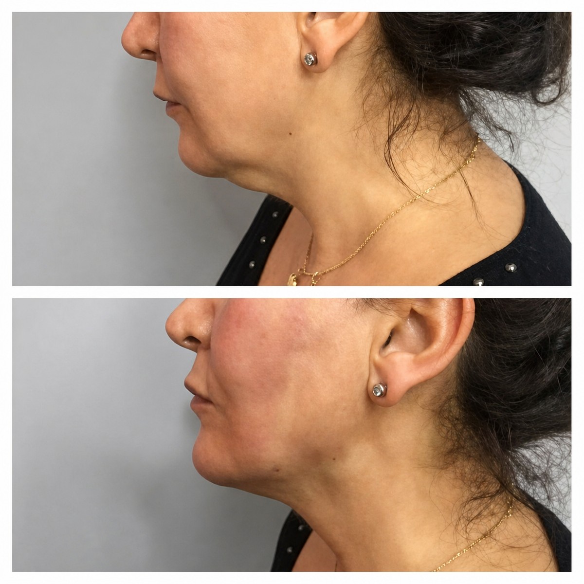 Before and after Botox injections at CE International Hospital, visible neck and jawline lift result