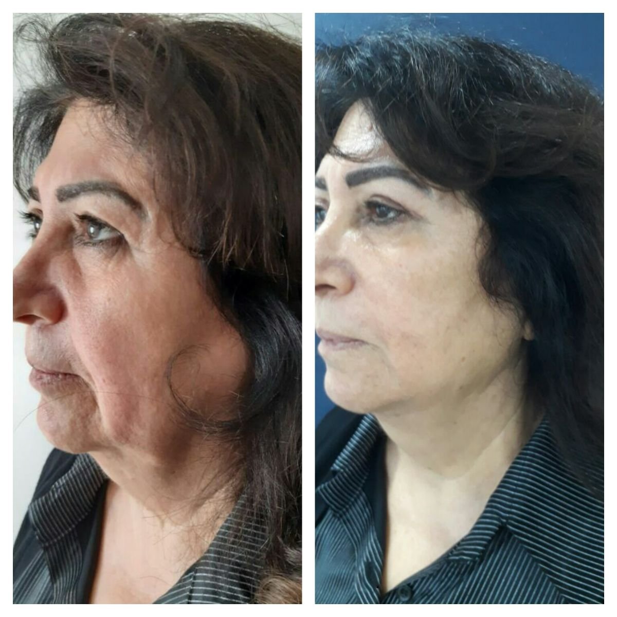 قبل وبعد حقن البوتوكس في CE International Hospital، تقليل تجاعيد الوجه