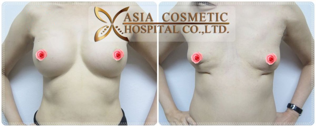 Résultats avant et après retrait d’implants mammaires à Asia Cosmetic Hospital, contour naturel