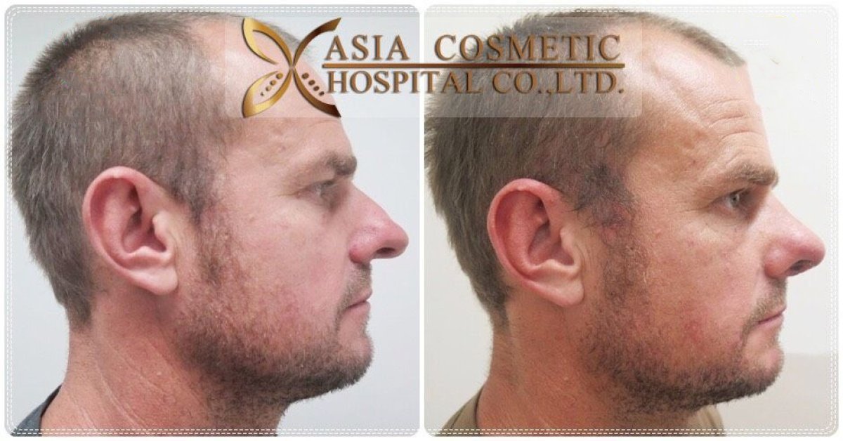 Resultados de septoplastia antes y después en Asia Cosmetic Hospital, perfil nasal mejorado