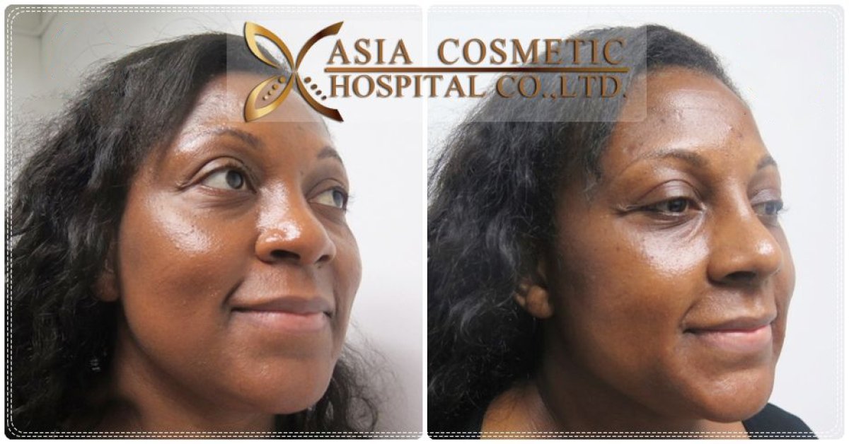 Before and after septoplasty results at Asia Cosmetic Hospital, improved nasal symmetry visible