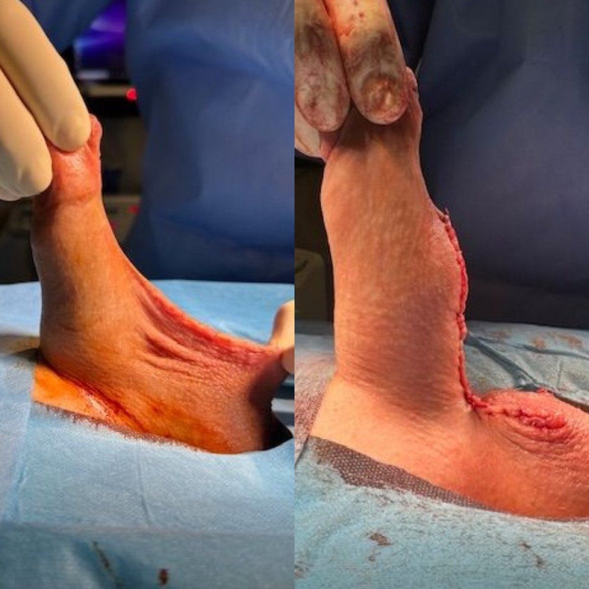 Résultats avant/après scrotoplastie chez Uroaesthetic, contour scrotal amélioré