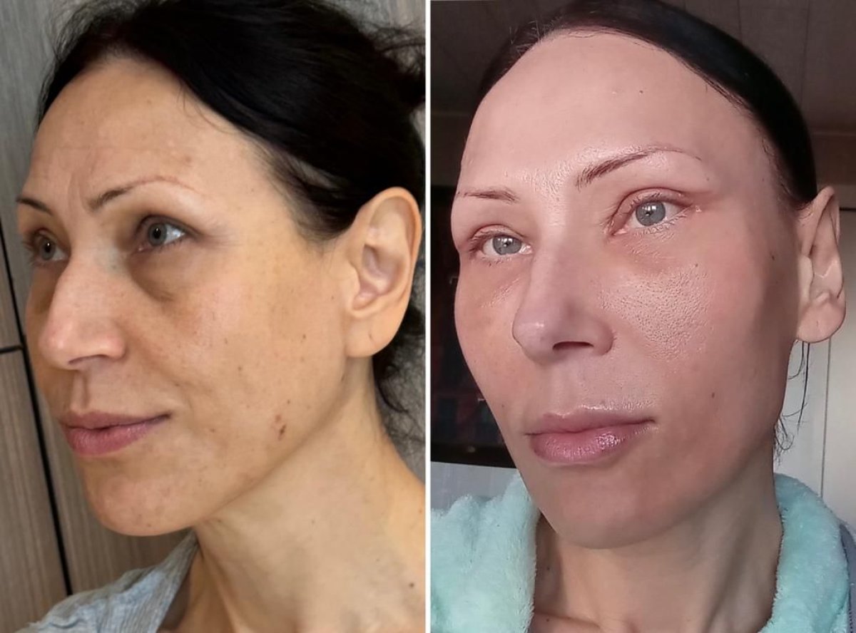 نتائج قبل وبعد Fox Eye Lift في عيادة Dr. Safa Manav، رفع الجفن بشكل ملحوظ