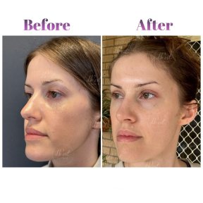 Blepharoplasty (Eyelid Correction Surgery) with European Board Certified Surgeon - photo 4