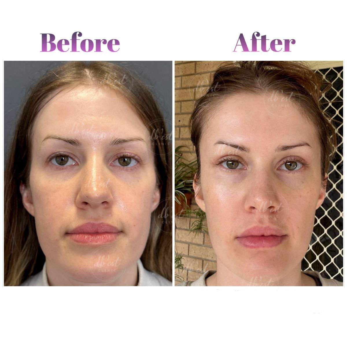 Resultados de blefaroplastia antes y después en Db'est Clinic, corrección de párpados