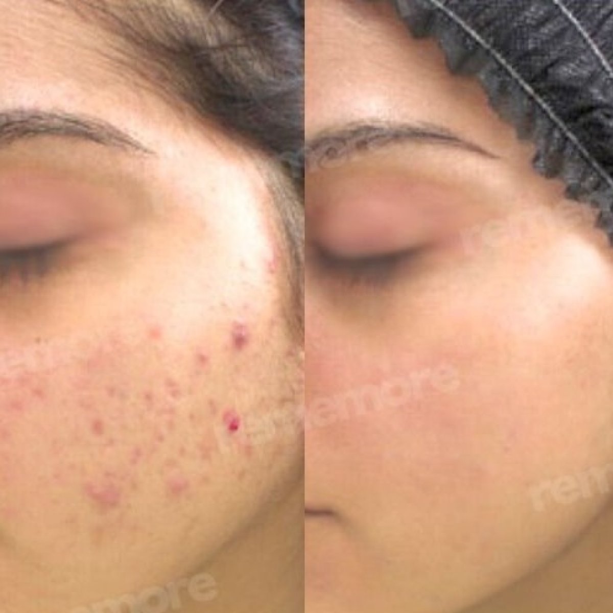Before and after laser skin resurfacing results at Memorial Şişli Hospital for acne scars