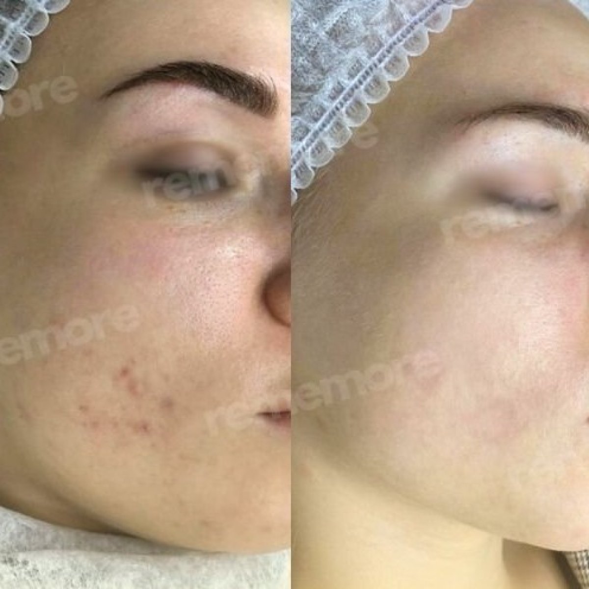 Before and after laser skin resurfacing at Memorial Şişli Hospital, improved facial skin texture