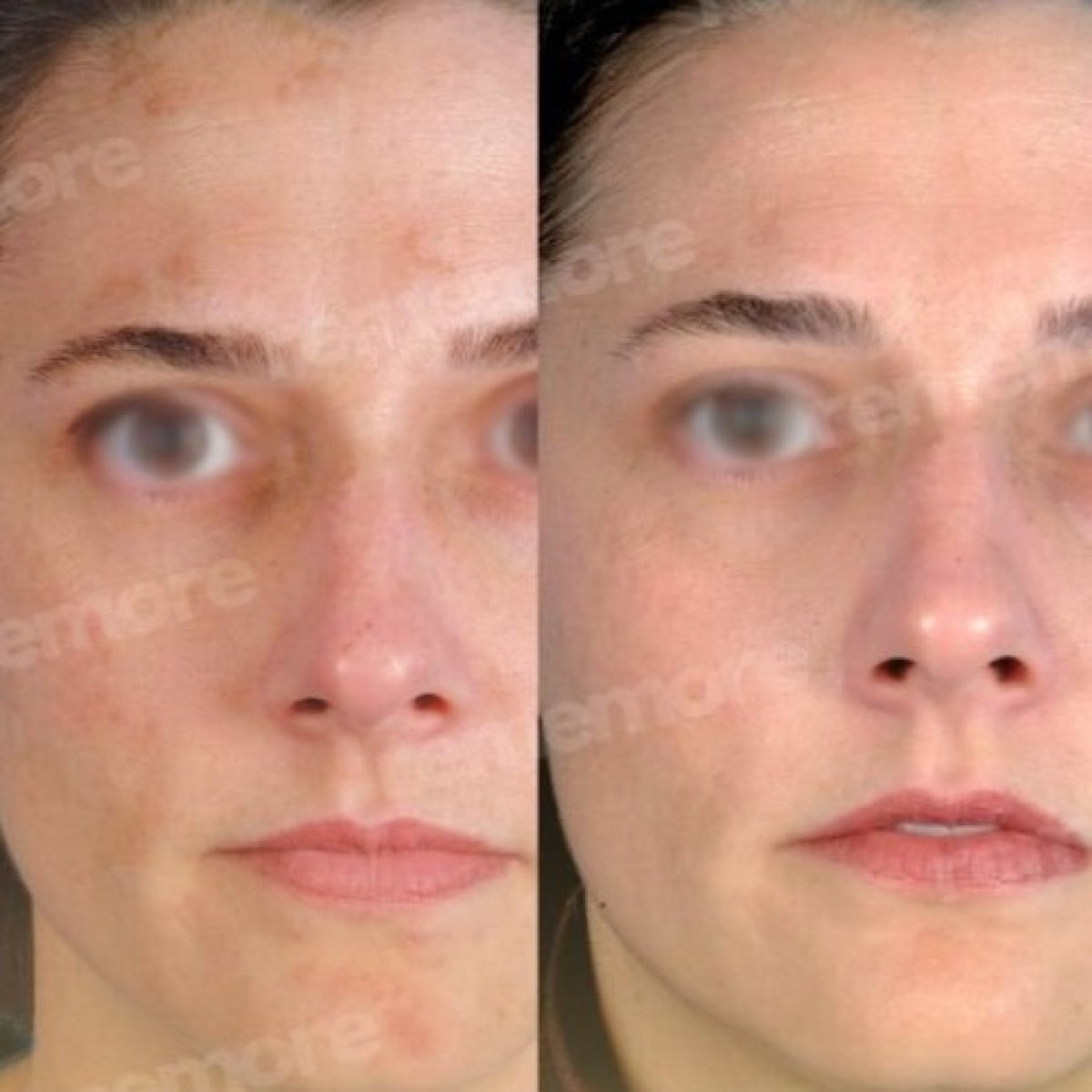 Before and after laser skin resurfacing at Memorial Şişli Hospital, improved facial skin texture result