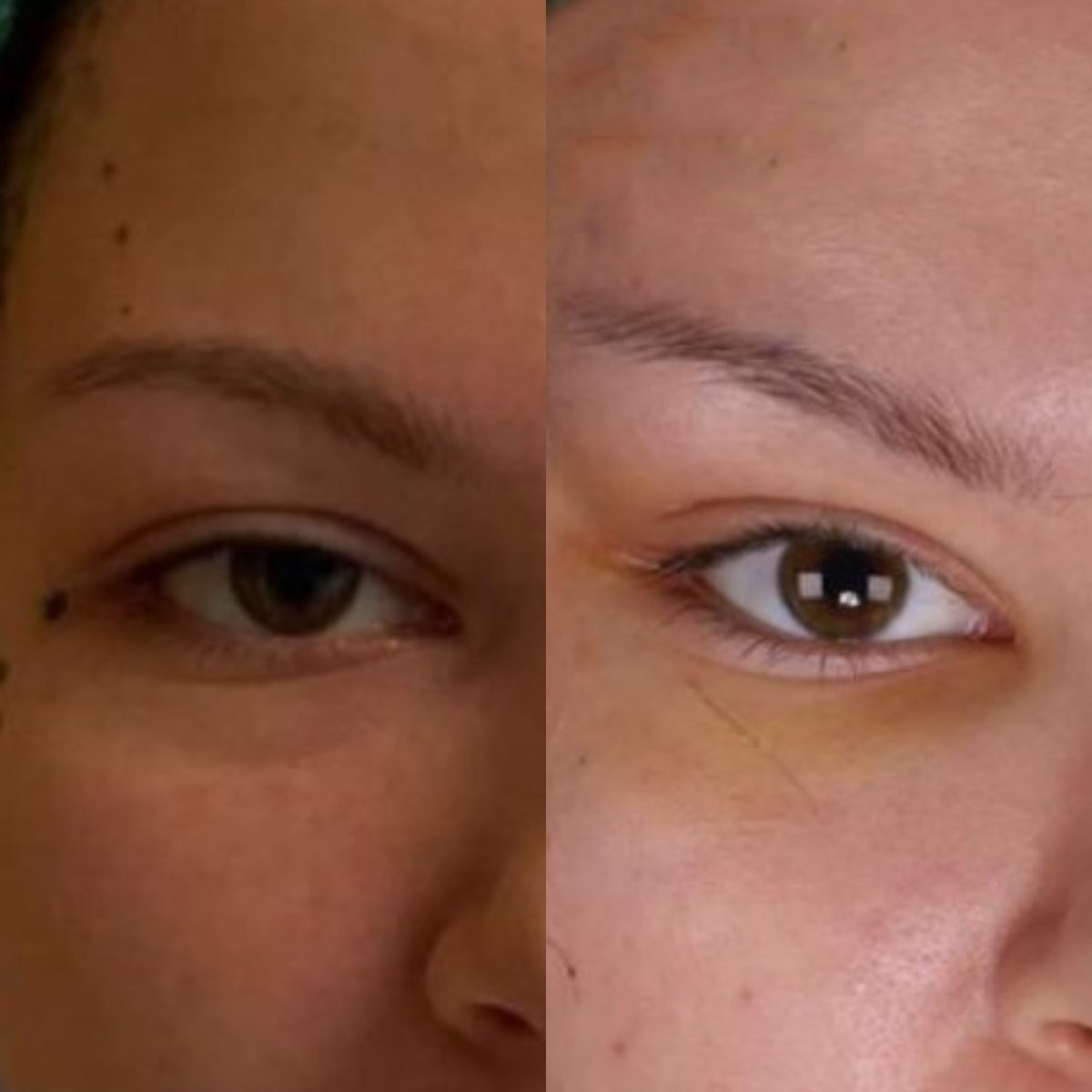 Fox Eye Lift before and after results at Dr. Safa Manav Clinic, lifted eyelid appearance