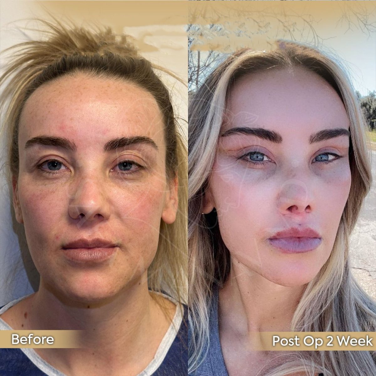 Fox Eye Lift before and after results at Dr. Safa Manav Clinic, enhanced eye contour visible