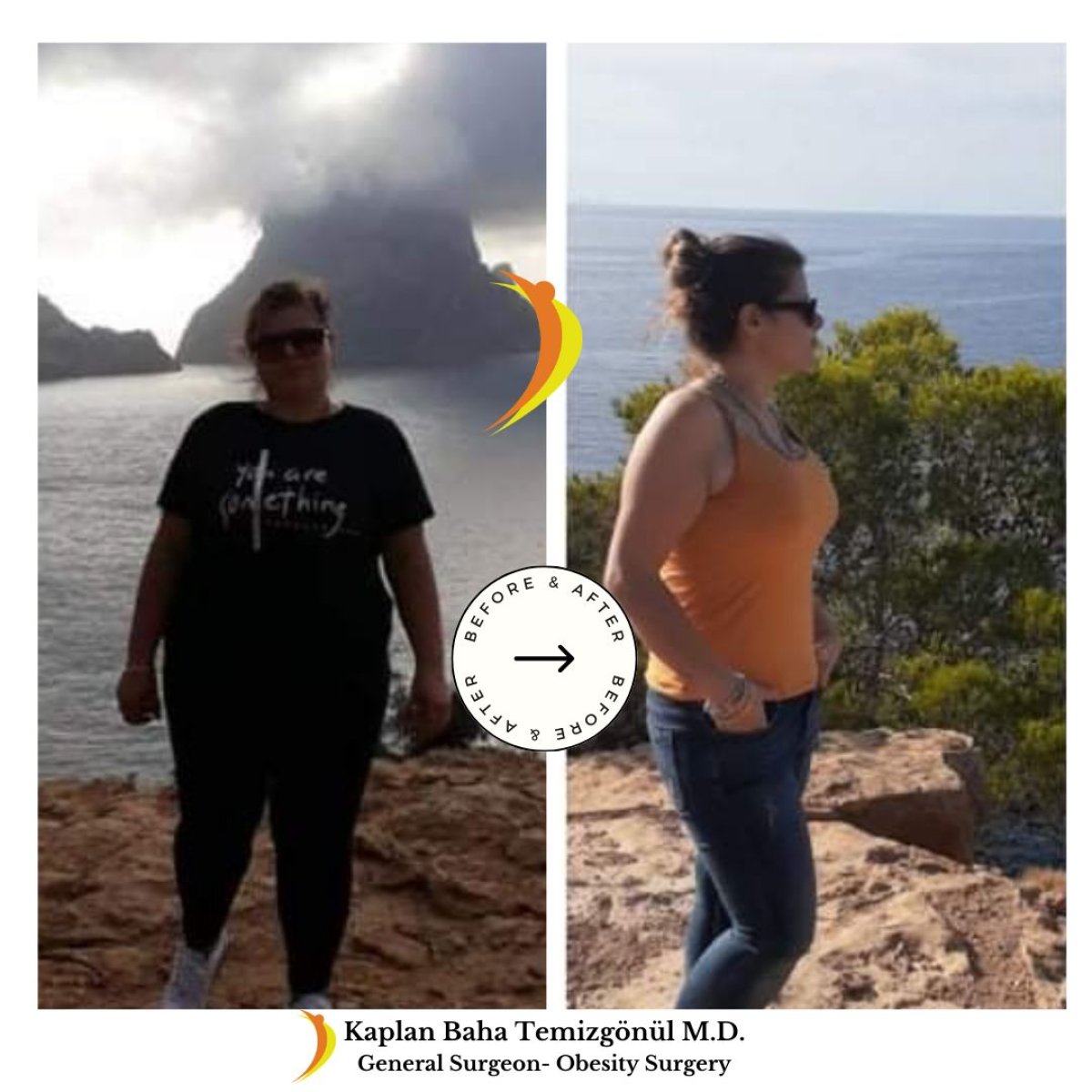 نتائج قبل وبعد جراحة تحويل مسار المعدة في Lotus Bariatrics Clinic – فقدان وزن ملحوظ