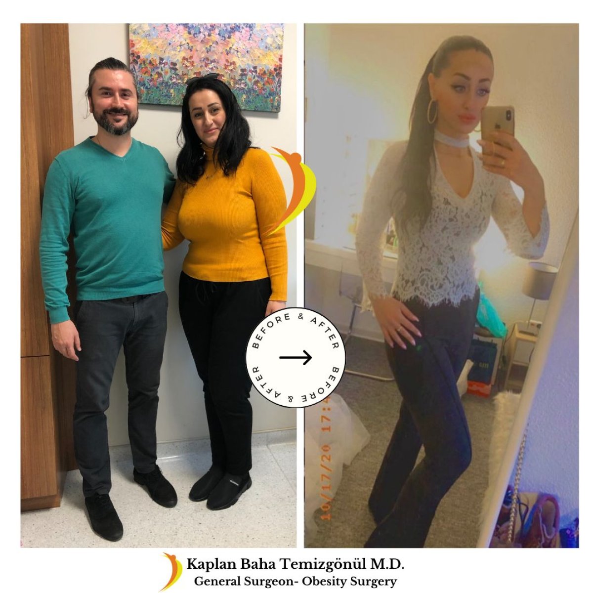 نتائج قبل وبعد جراحة تحويل مسار المعدة في Lotus Bariatrics Clinic – فقدان وزن ملحوظ