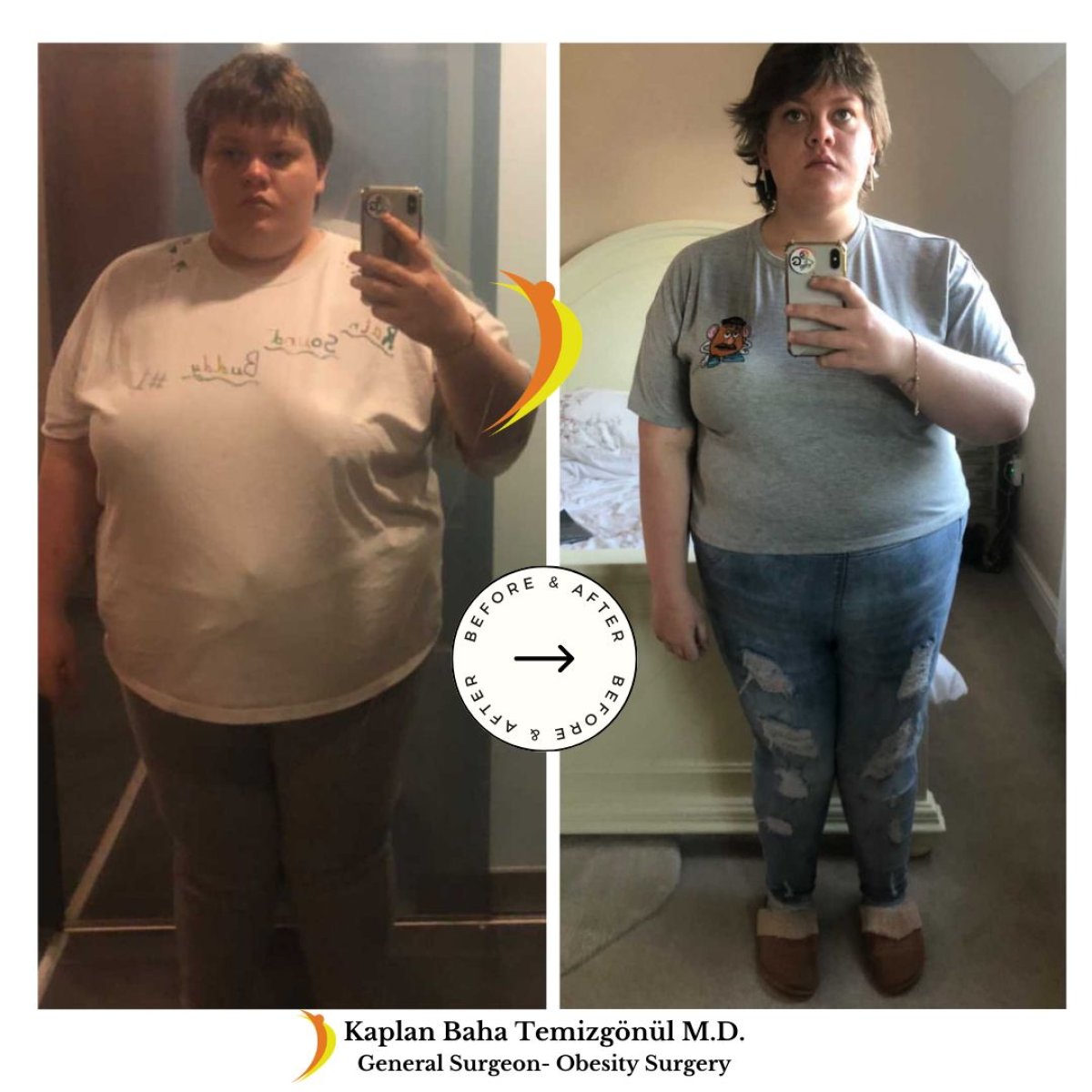 Результаты до и после гастрошунтирования в Lotus Bariatrics Clinic – заметная потеря веса