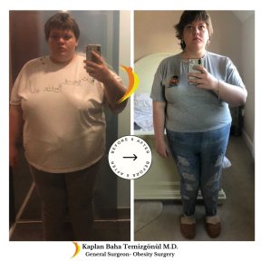 Gastric Bypass and Revisions for Bariatric Surgery - photo 4