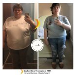 Before and after Желудочное шунтирование photos by Dr. Каплан Баха Темизгонул