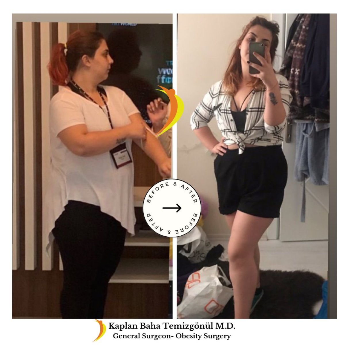 نتائج قبل وبعد جراحة تحويل مسار المعدة في Lotus Bariatrics Clinic – فقدان وزن كبير