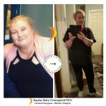 Before and after Желудочное шунтирование photos by Dr. Каплан Баха Темизгонул