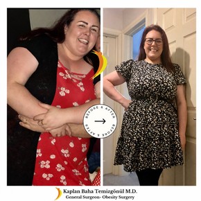 Gastric Bypass and Revisions for Bariatric Surgery - photo 6