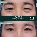 Dr. Park Young Kyu тарапынан Блефаропластика (қабақ қалыпқа келтіру) бұрын және кейін фотосуреттері