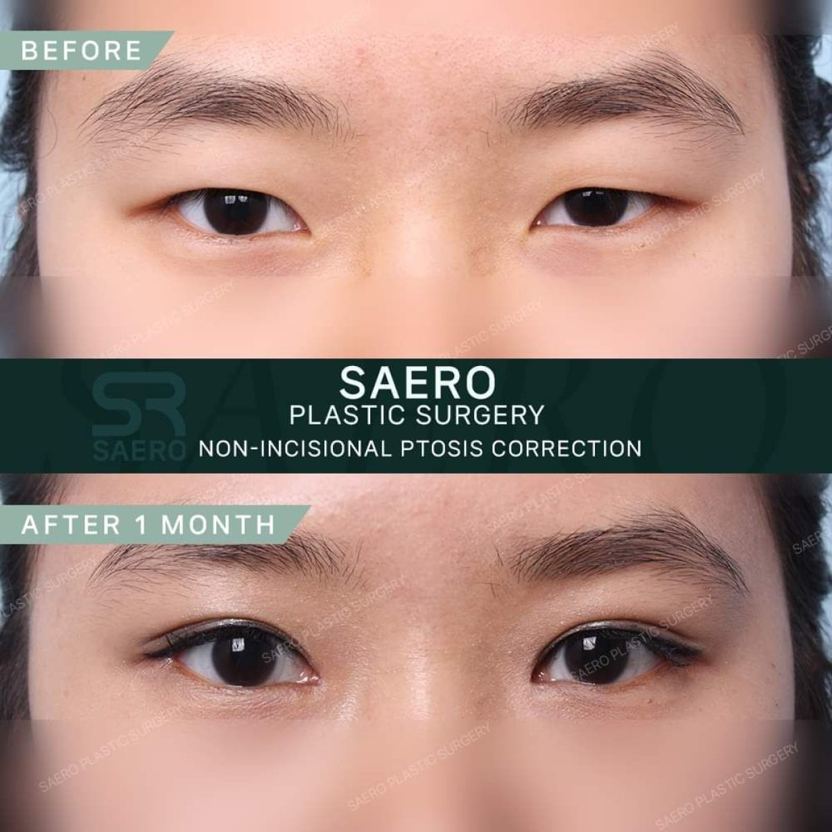 До и после безразрезной коррекции птоза век в SAERO Plastic Surgery, результат подтяжки