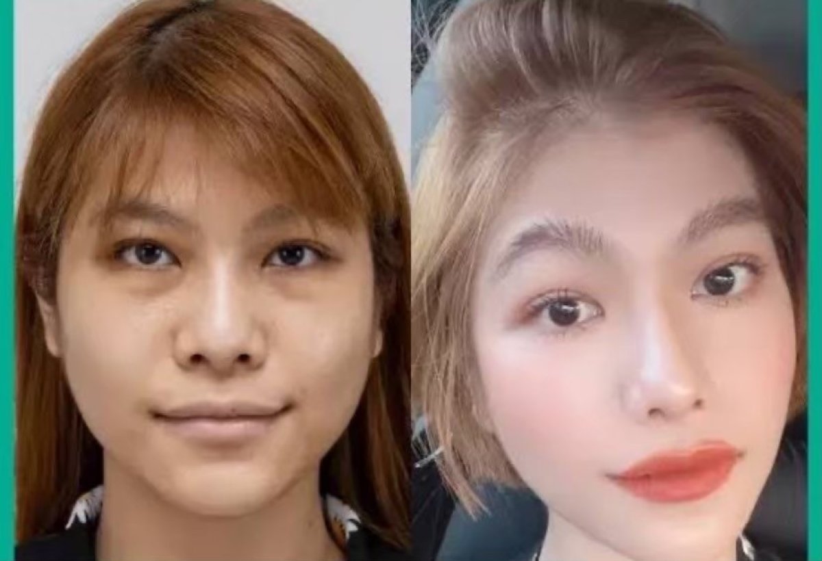 Before and after alarplasty results at ID Clinic Bangkok, nose reshaping for refined look