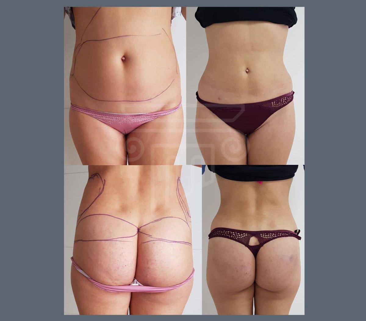 Résultats avant/après liposuccion du dos à la clinique Dr. Safa Manav, silhouette affinée