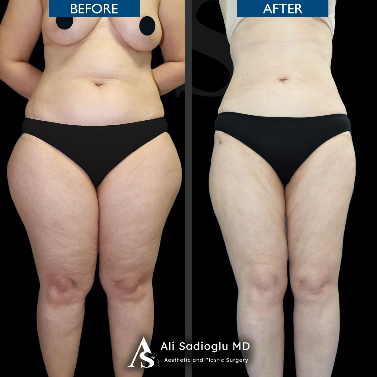 Full body lift before and after results at Dr. Safa Manav Clinic, improved body contour