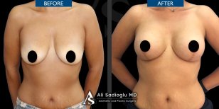 Before and after Вазер (Vaser) липосакция photos by Dr. Ali Sadioglu Md