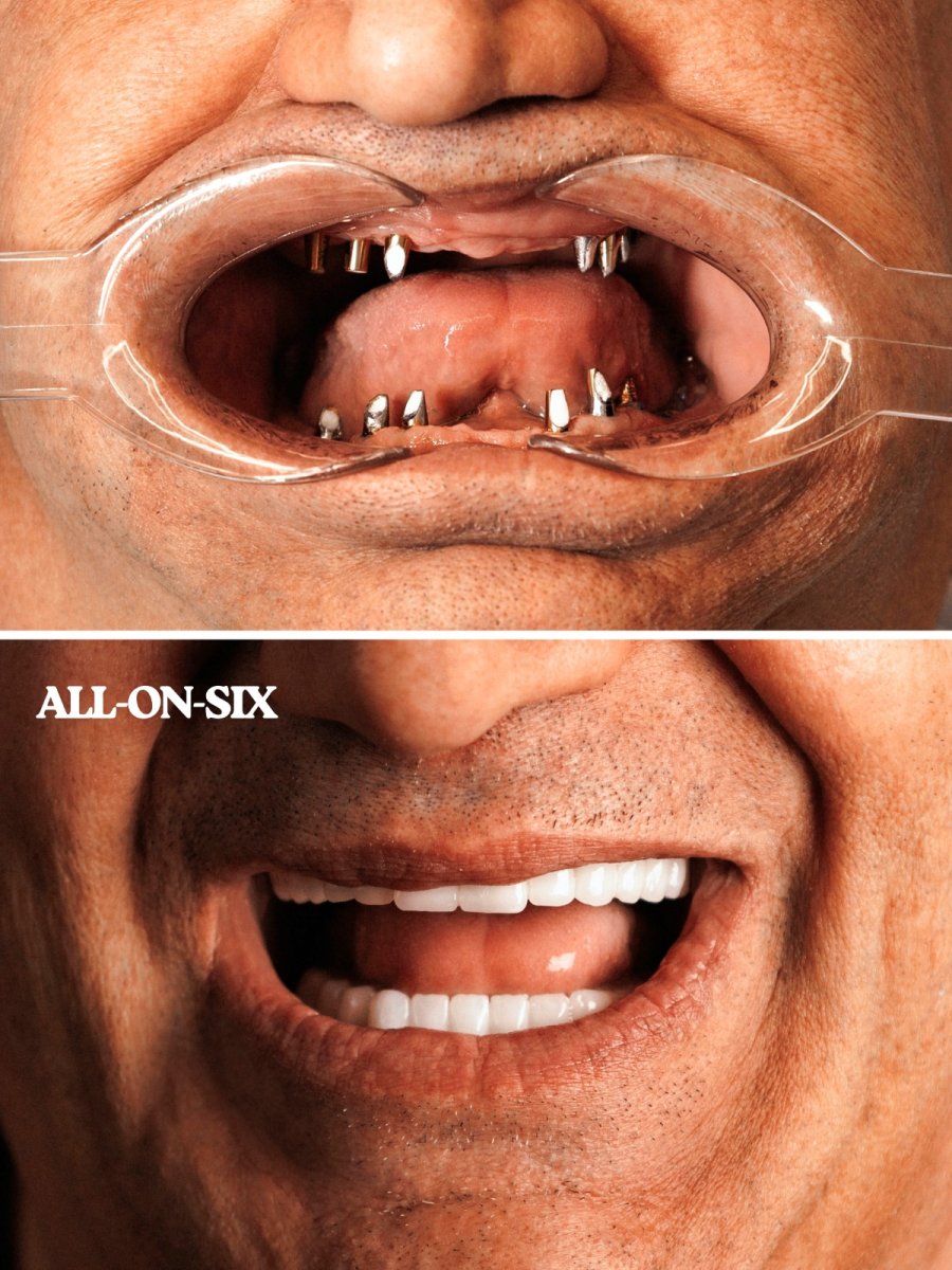 Resultados antes y después de implantes dentales All-on-6 en WestDent Clinic, sonrisa restaurada
