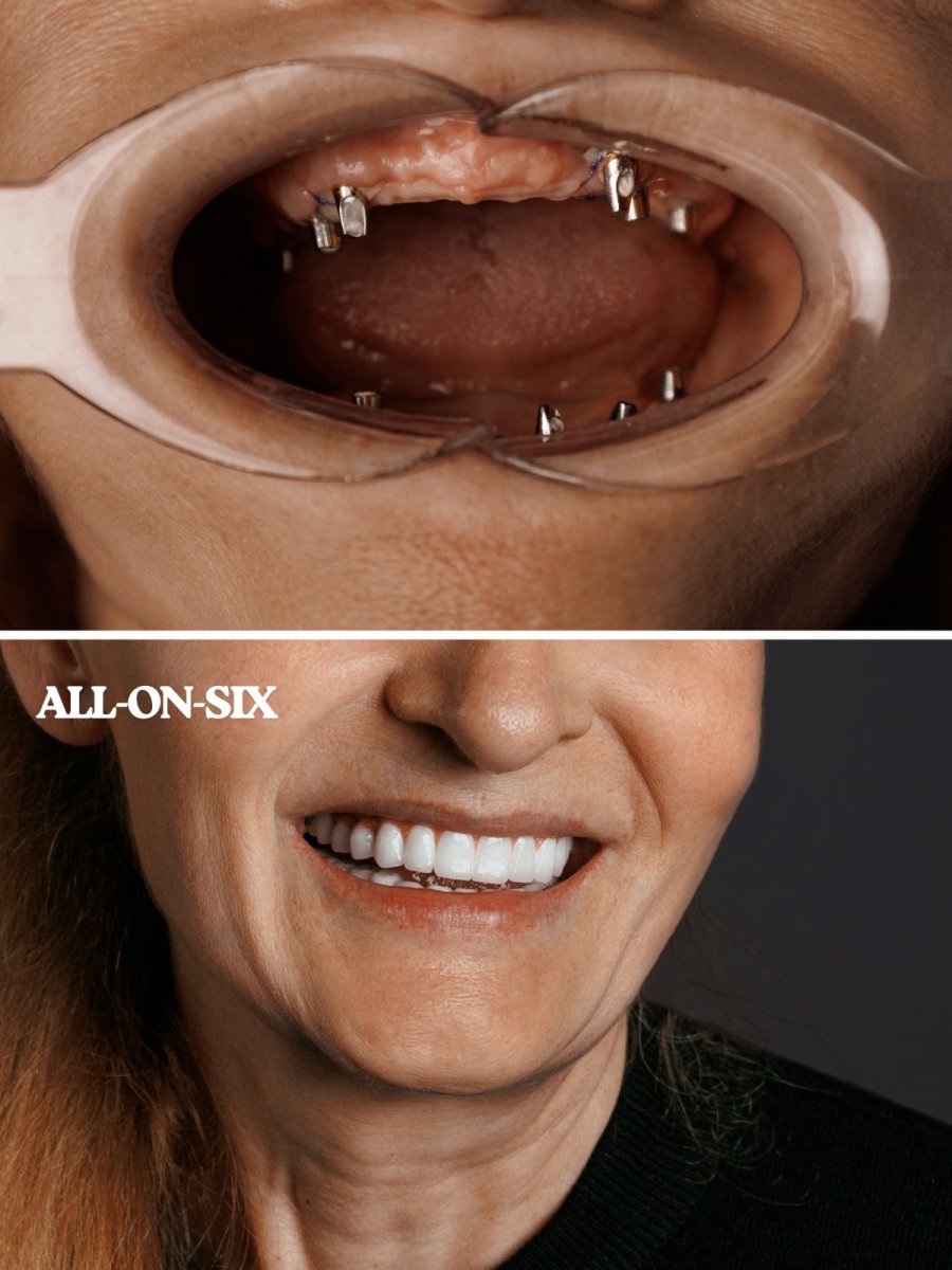 Before and after All-on-6 dental implant results at WestDent Clinic, full smile restoration