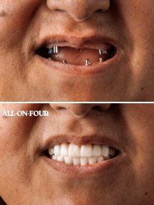 1 TOOTH İMPLANTATİON - photo 2