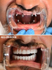 1 TOOTH İMPLANTATİON - photo 4