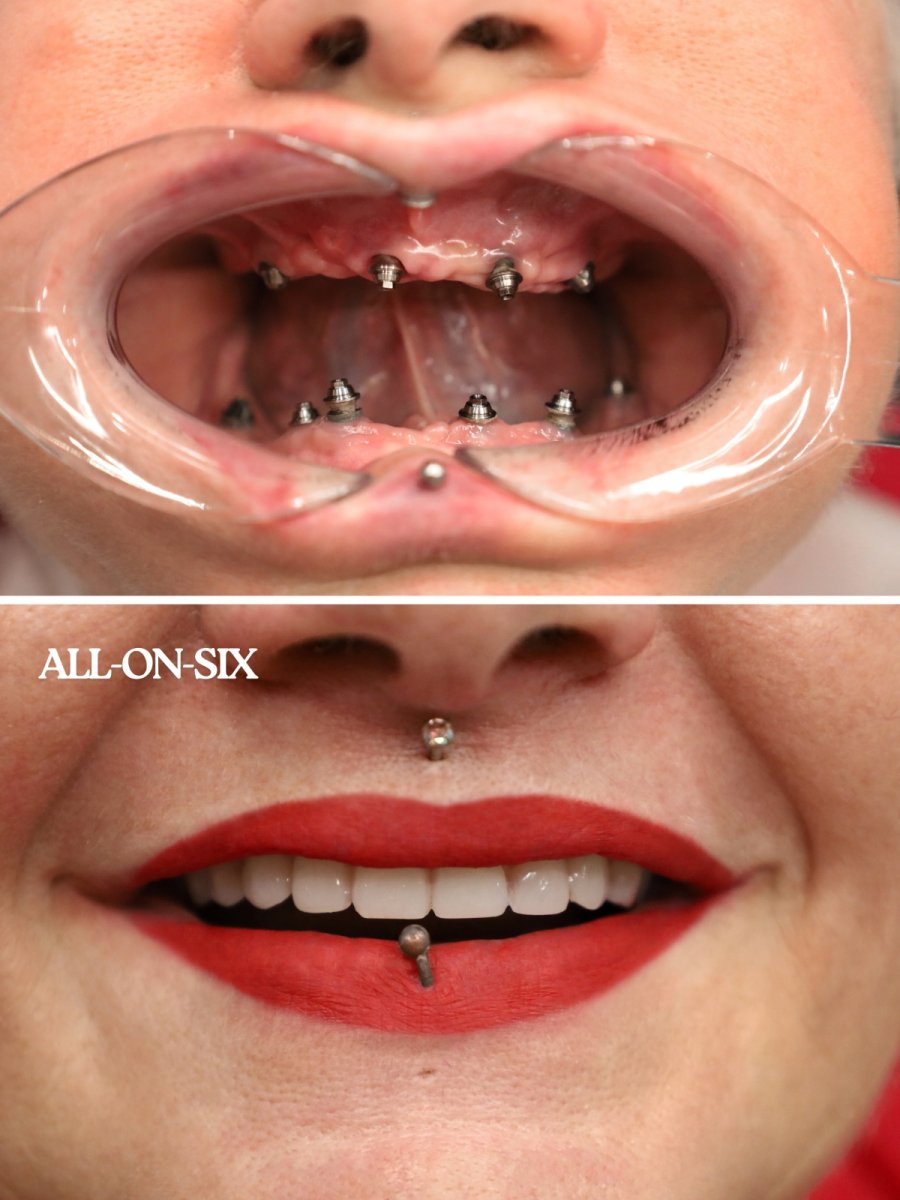 نتائج قبل وبعد زراعة الأسنان All-on-6 في WestDent Clinic، استعادة الابتسامة الكاملة