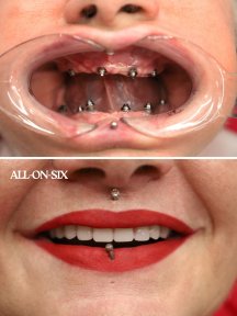 1 TOOTH İMPLANTATİON