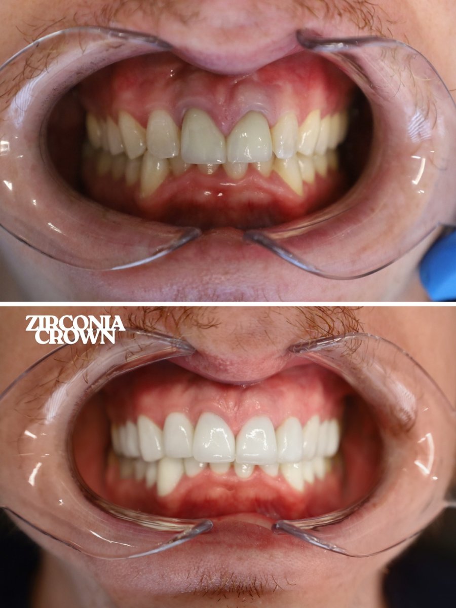 Before and after zirconia crown installation at WestDent Clinic – improved smile aesthetics result