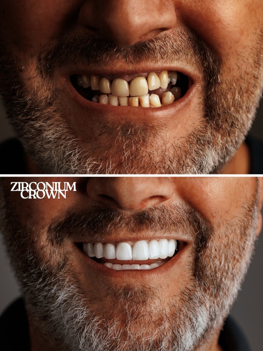 Before and after zirconia crown results at WestDent Clinic – smile transformation for men